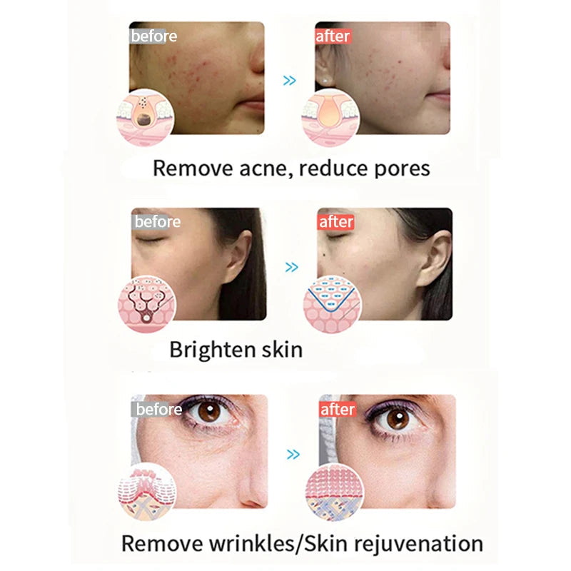 LED Face Perfecting Light Therapy